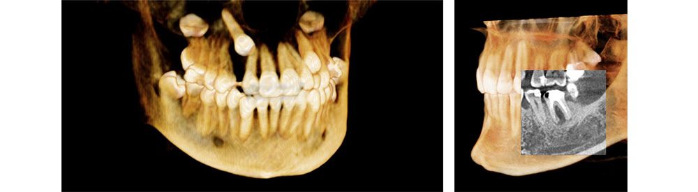歯科用CT（Computed Tomography：コンピュータ断層撮影）装置
