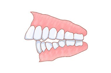 上顎前突（じょうがくぜんとつ） イメージ