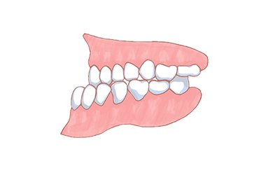 下顎前突（ががくぜんとつ）/受け口 イメージ