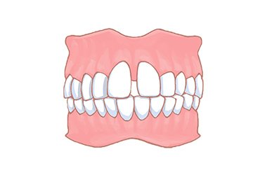 空隙歯列（くうげきしれつ） イメージ