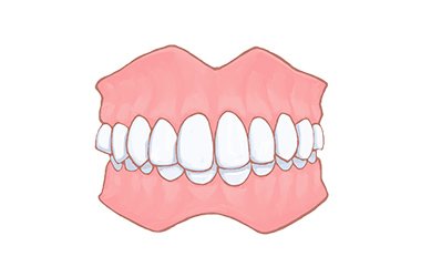 過蓋咬合（かがいこうごう） イメージ