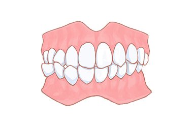 交叉咬合（こうさこうごう） イメージ