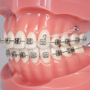 アンカースクリュー イメージ