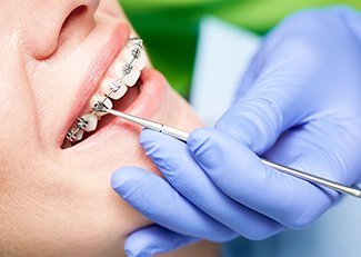 術前矯正(約1~2年) イメージ