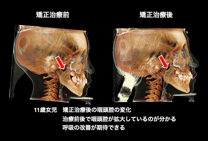 顎顔面矯正のメリット イメージ