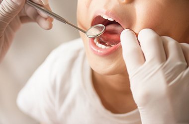 上顎の成長リミットと治療のタイミング イメージ