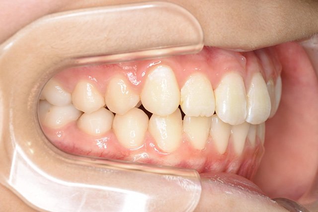 全顎ワイヤー矯正　症例