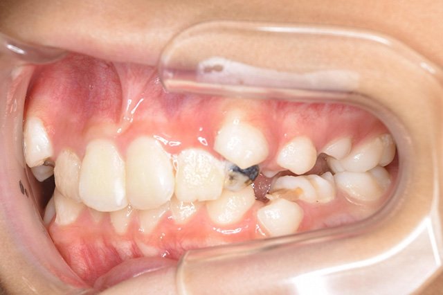 全顎ワイヤー矯正　症例