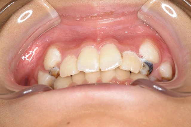 全顎ワイヤー矯正　症例