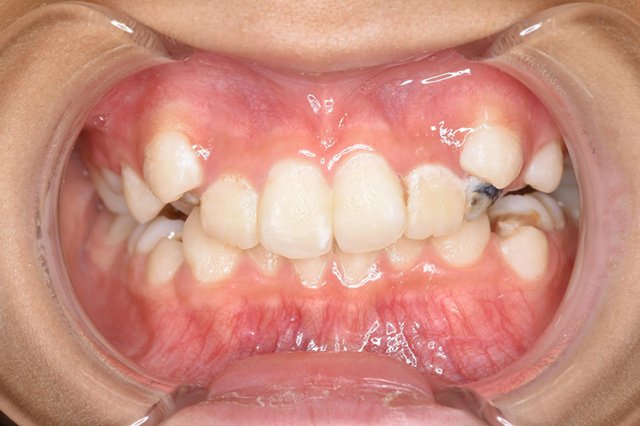 全顎ワイヤー矯正　症例