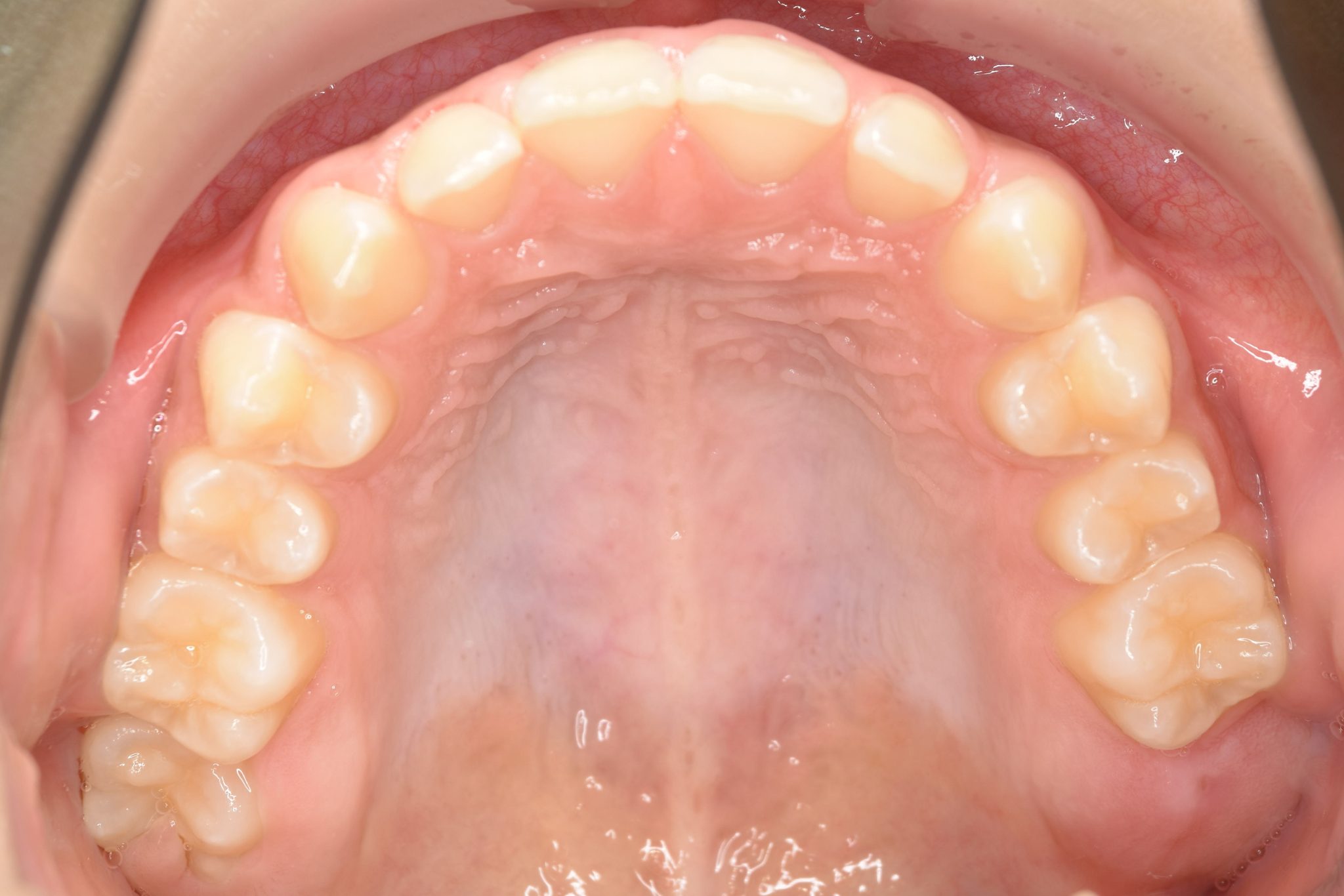 全顎ワイヤー矯正　症例_108