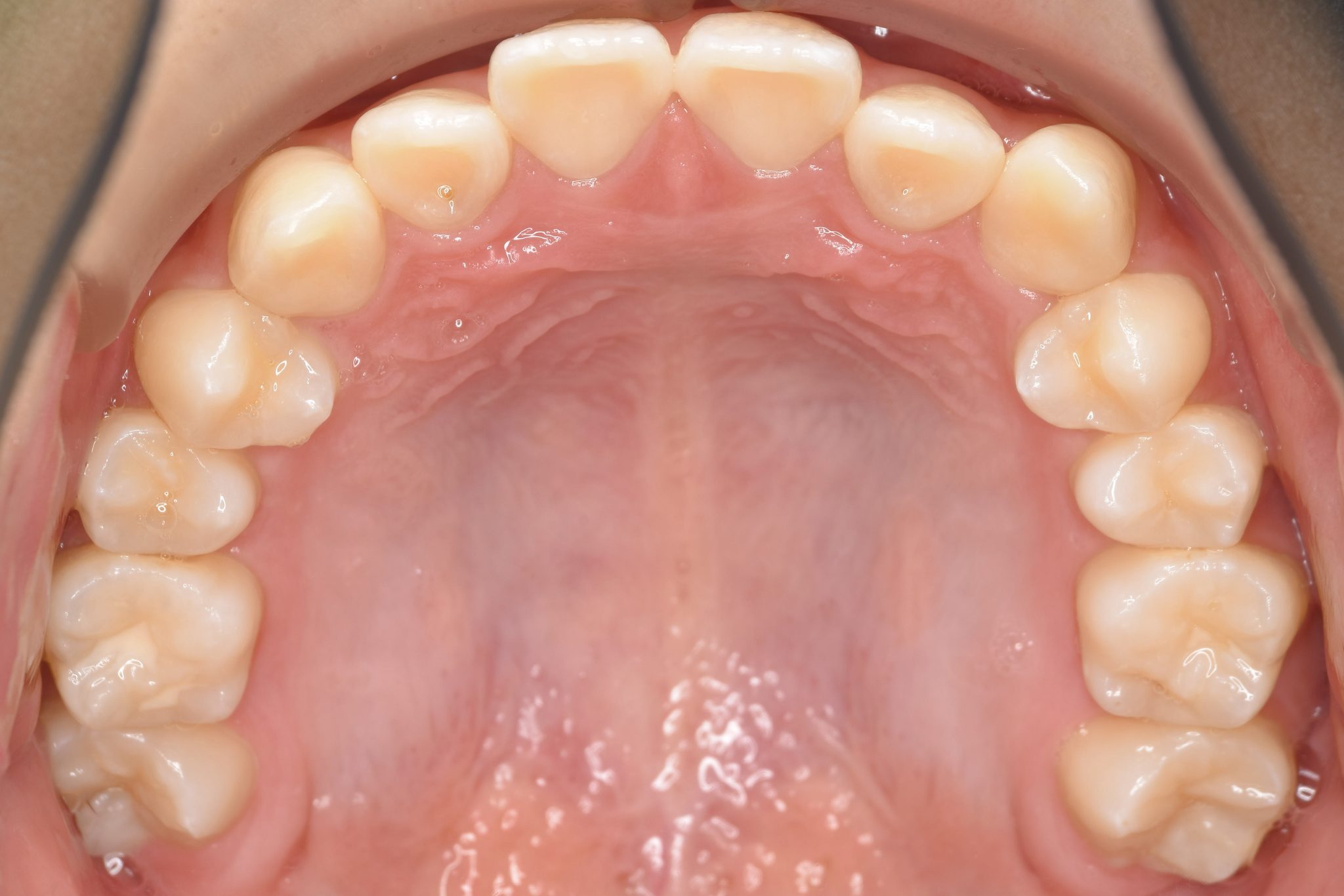 全顎ワイヤー矯正　症例_185