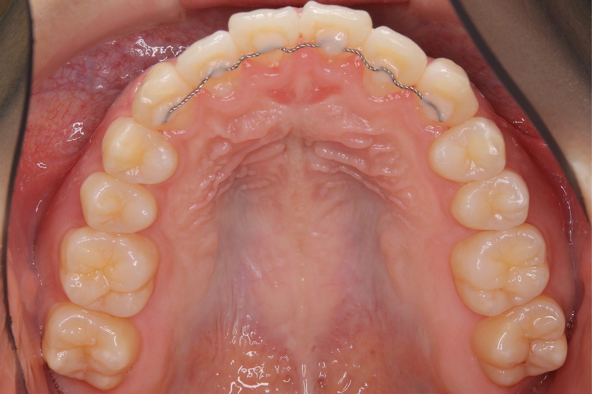 全顎ワイヤー矯正　症例_191
