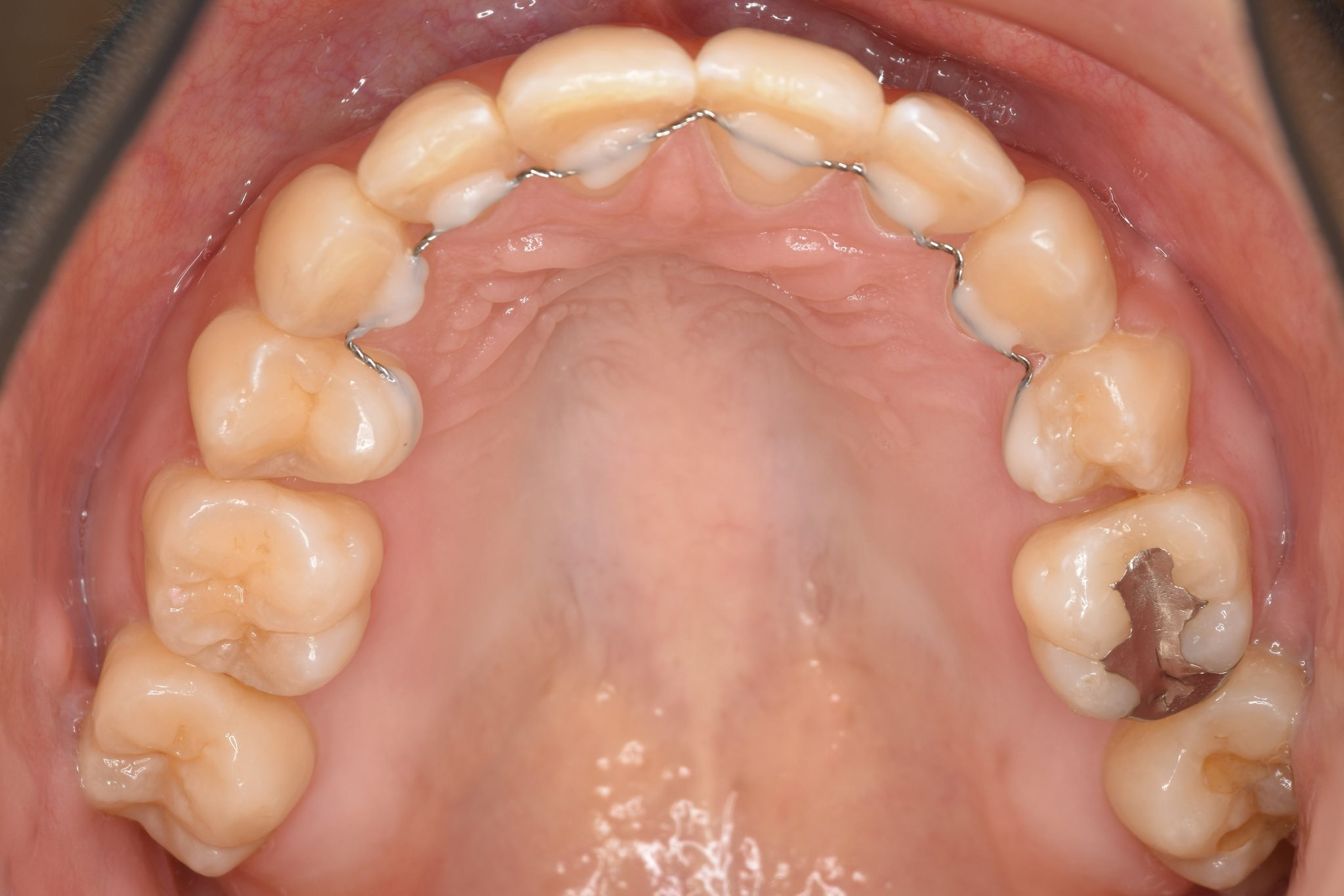 全顎ワイヤー矯正　症例_200