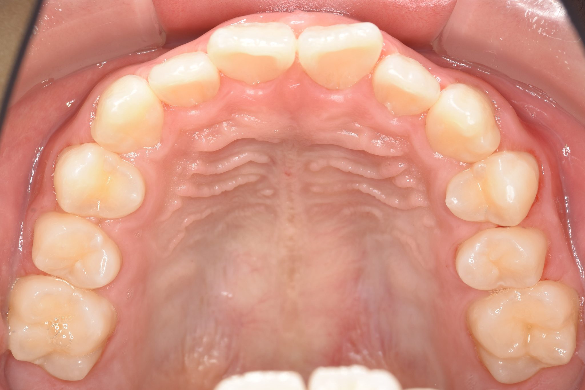 全顎ワイヤー矯正　症例_218