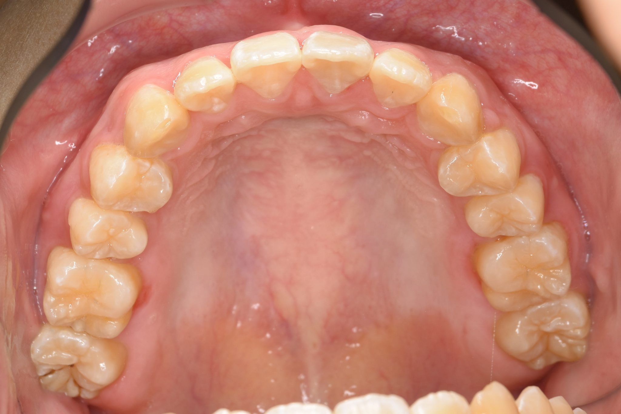 全顎ワイヤー矯正　症例_252