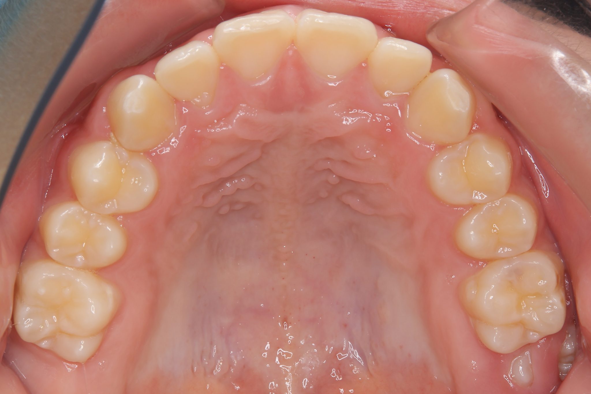 全顎ワイヤー矯正　症例_261