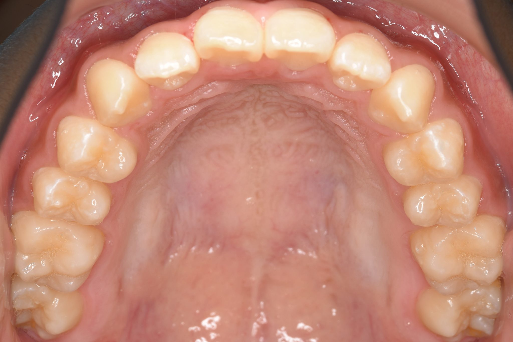 全顎ワイヤー矯正　症例_267