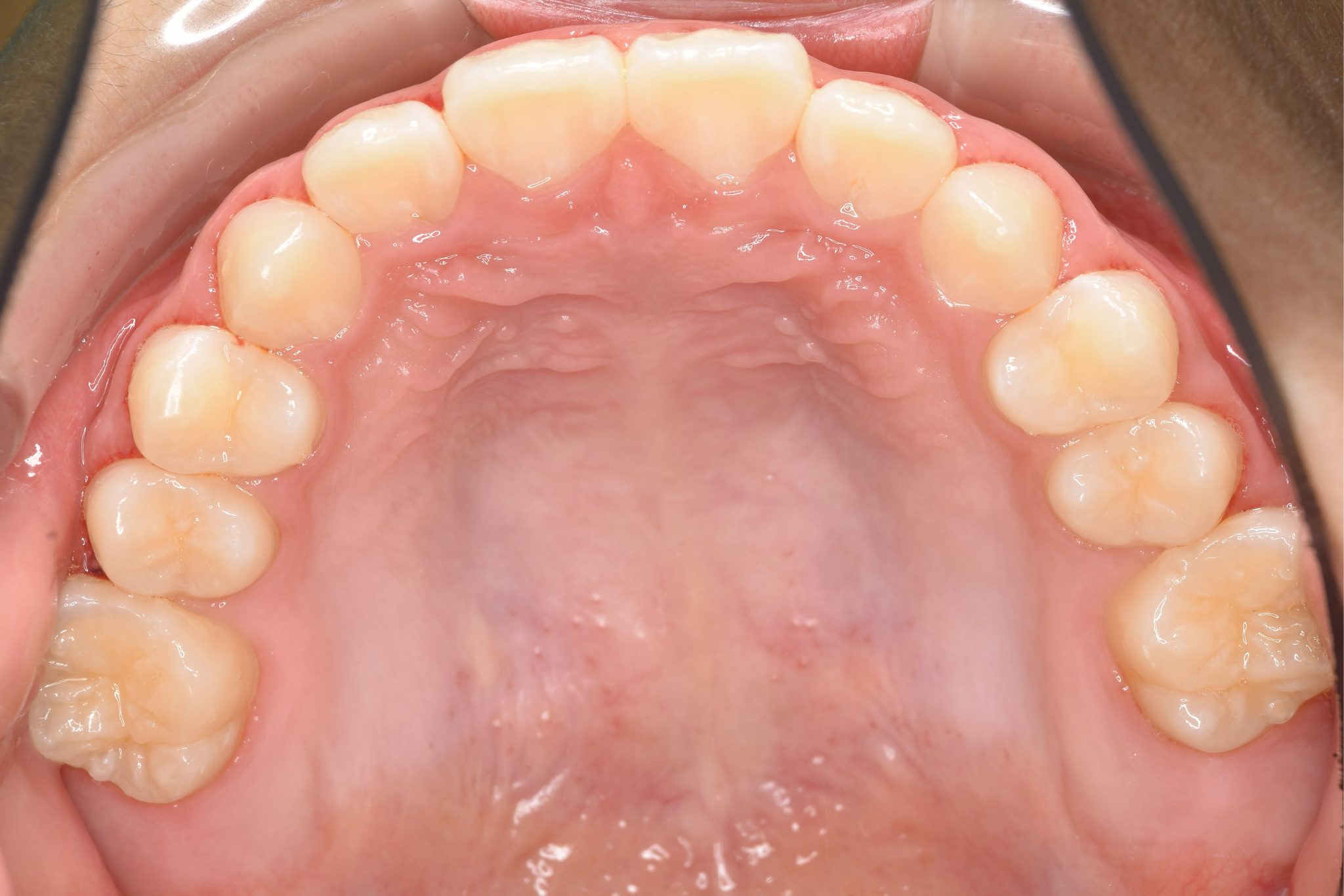 全顎ワイヤー矯正　症例_276