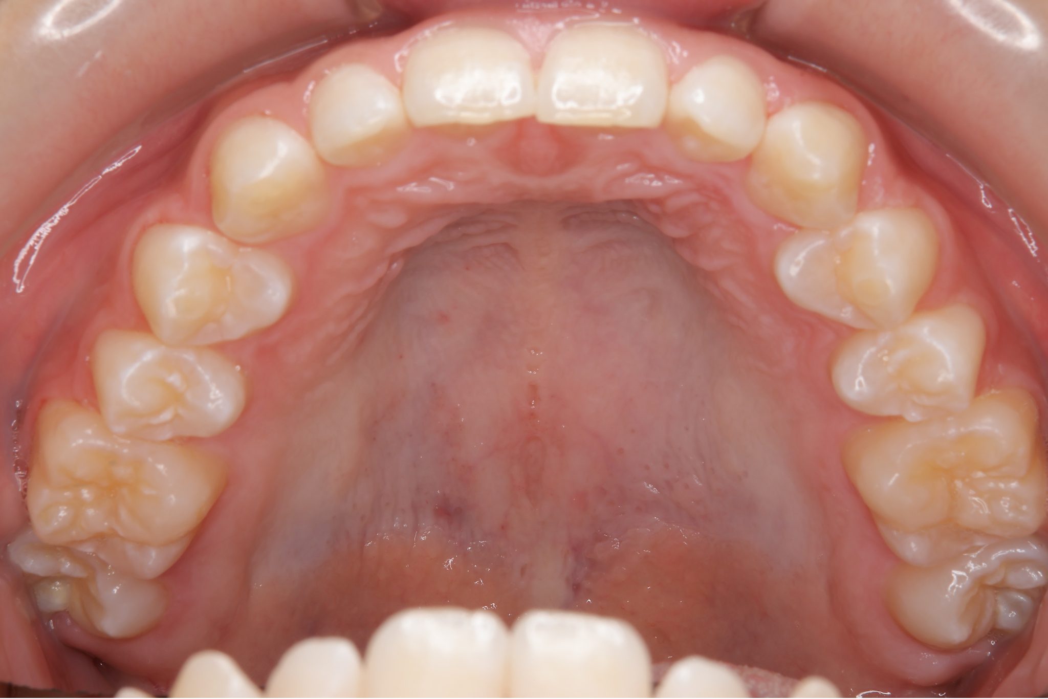 全顎ワイヤー矯正　症例_121