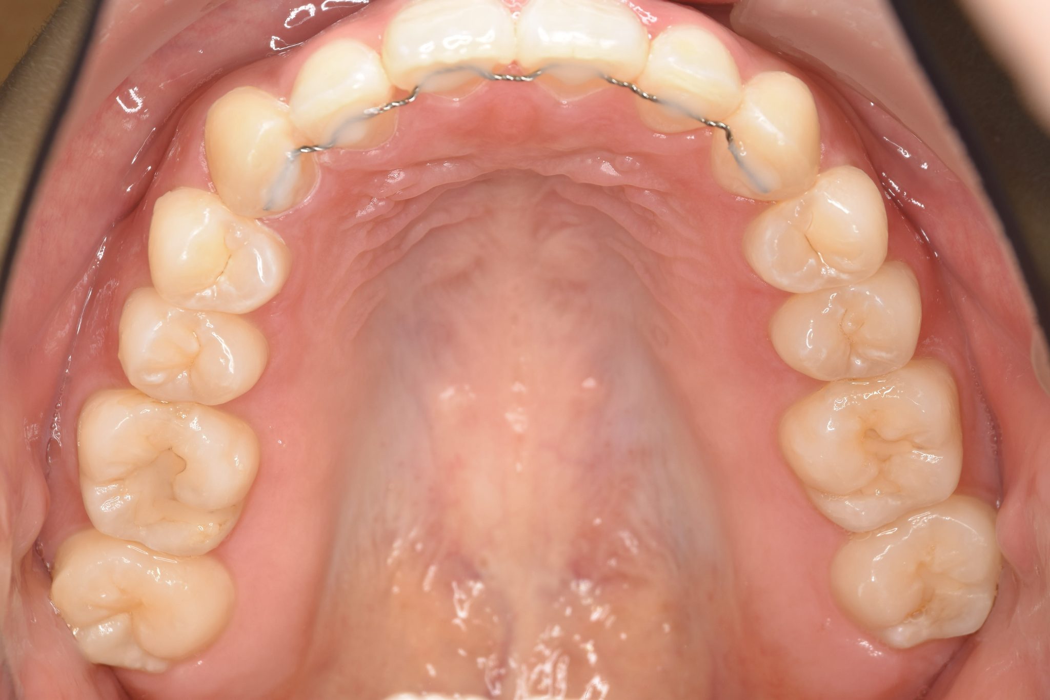 全顎ワイヤー矯正　症例_306