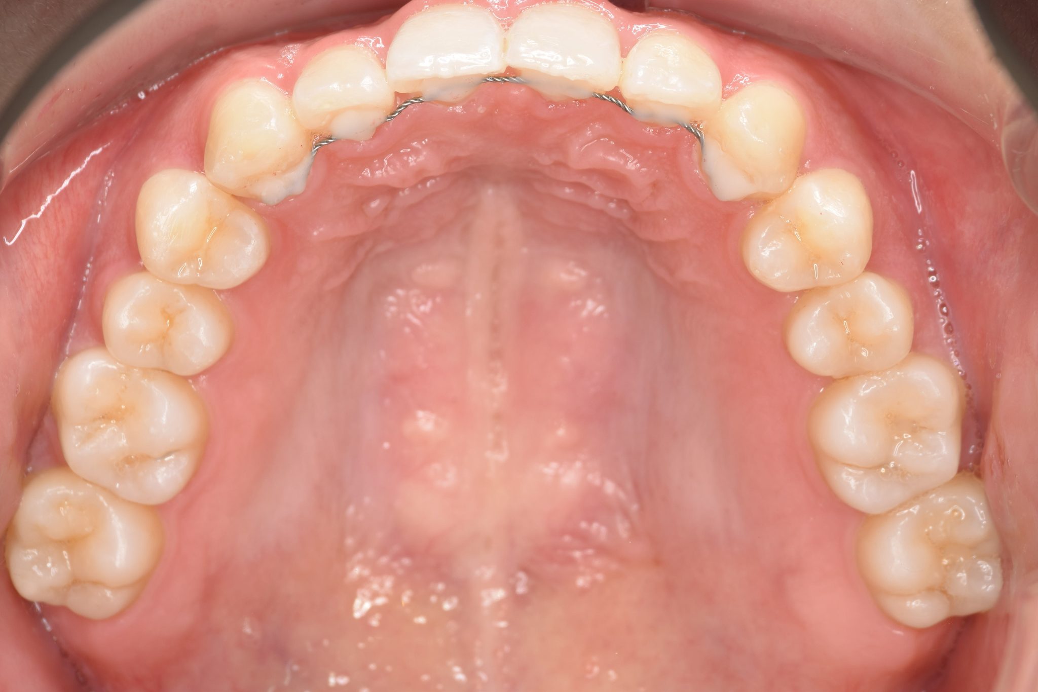 全顎ワイヤー矯正　症例_315