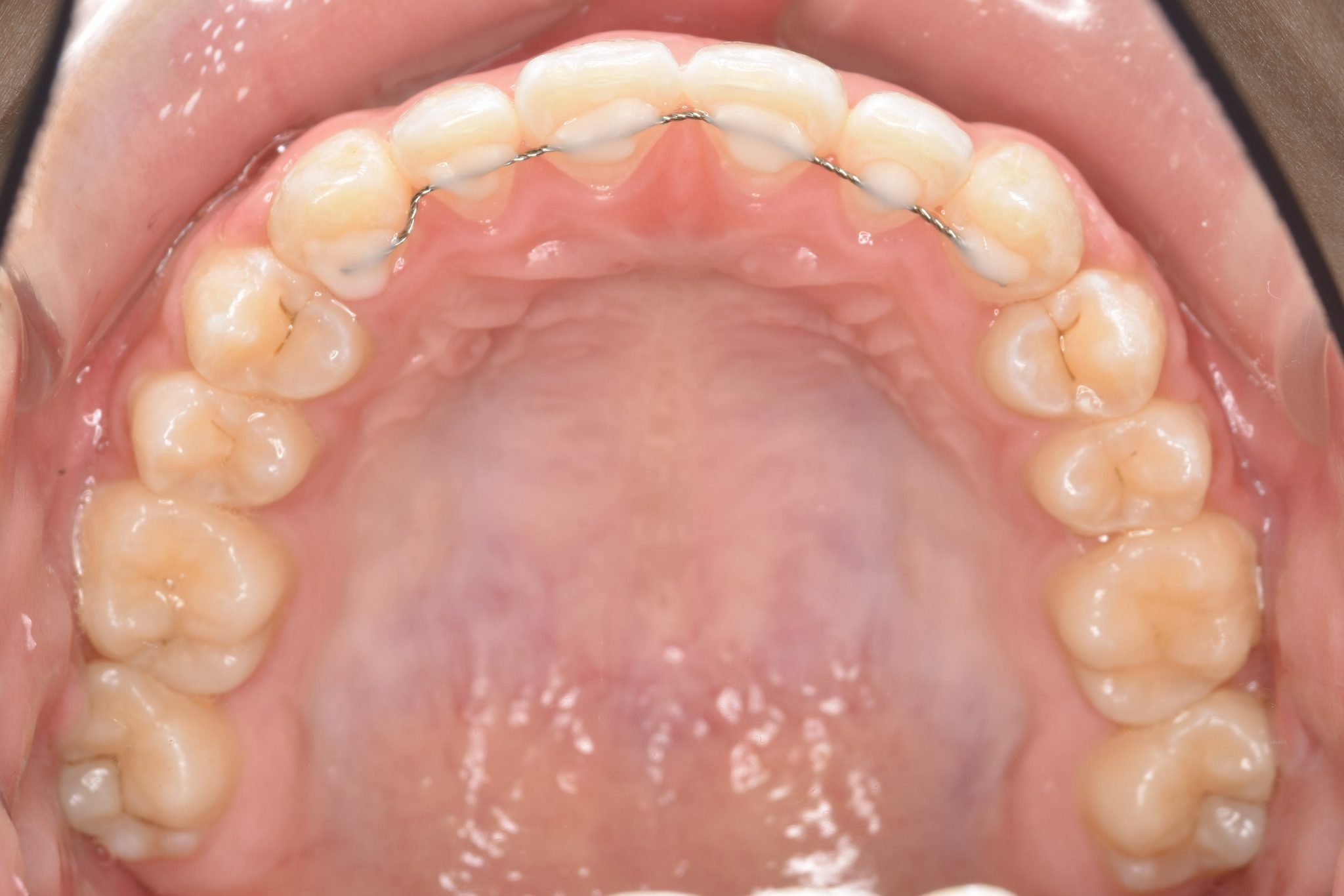全顎ワイヤー矯正　症例_320
