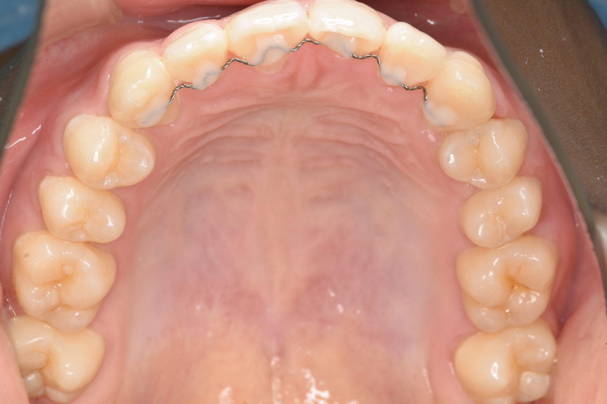 全顎ワイヤー矯正　症例_323