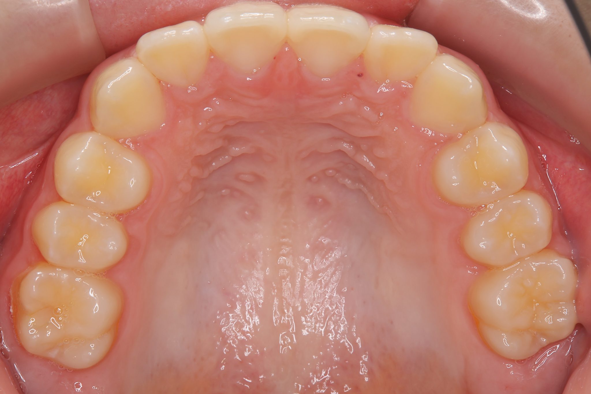 全顎ワイヤー矯正　症例_347