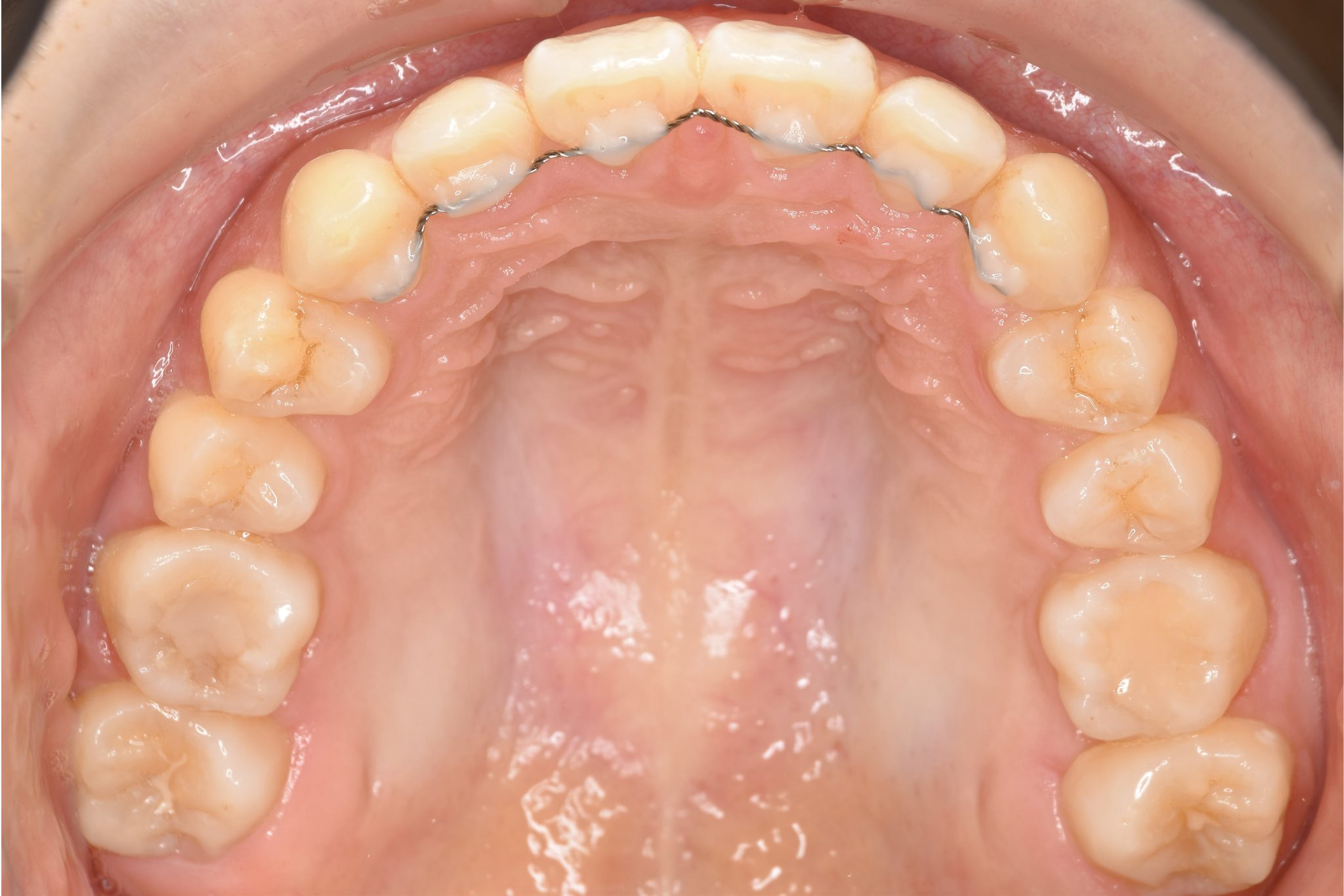 全顎ワイヤー矯正　症例_349