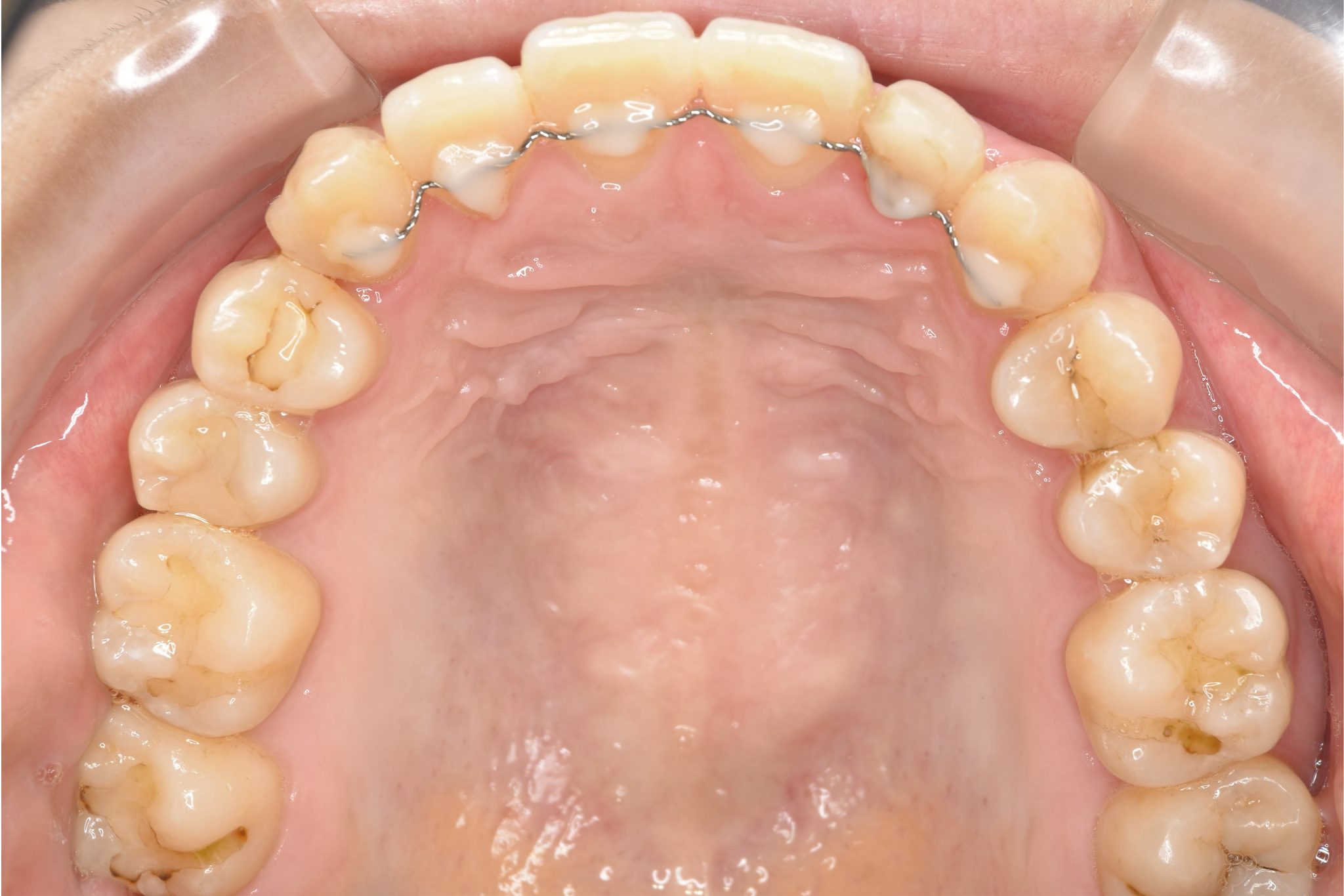 全顎ワイヤー矯正　症例_401