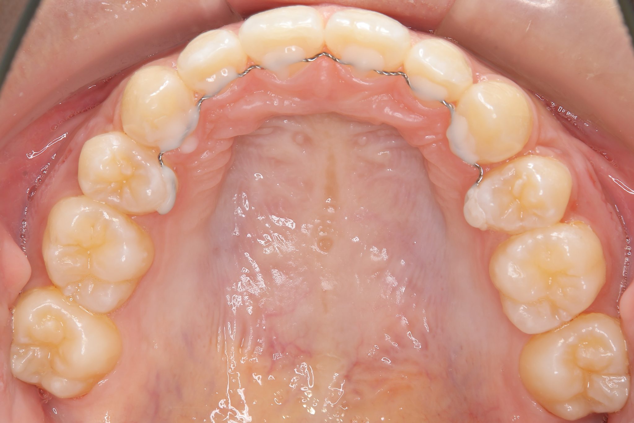 全顎ワイヤー矯正　症例_418