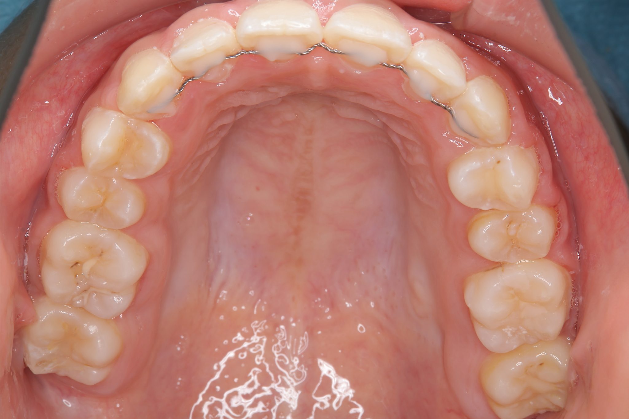 全顎ワイヤー矯正　症例_474