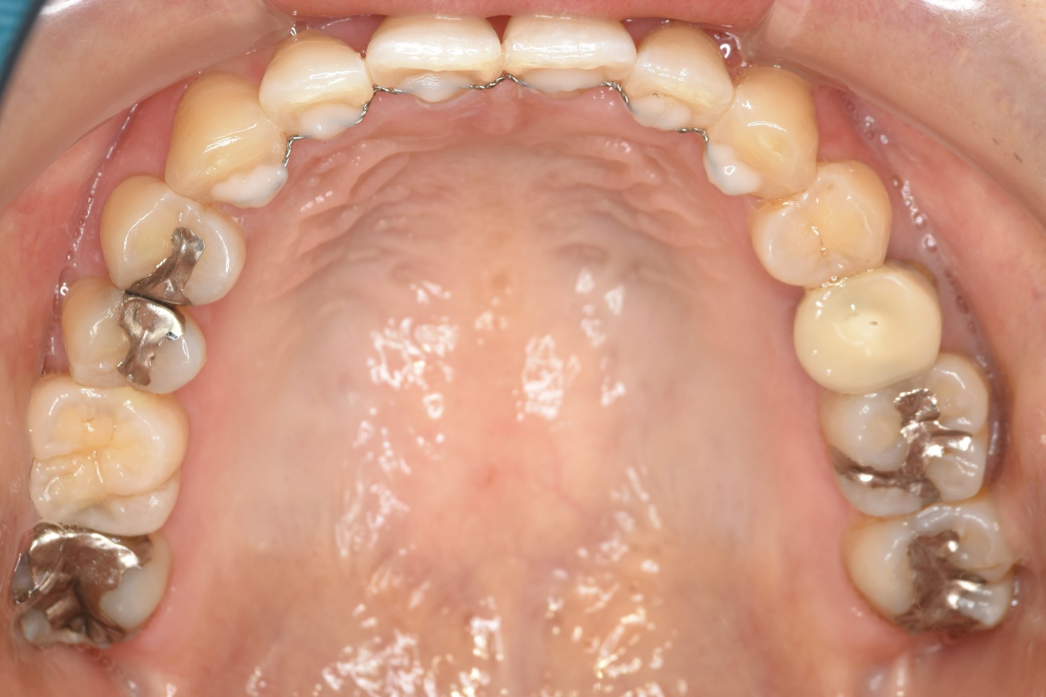 全顎ワイヤー矯正　症例_479