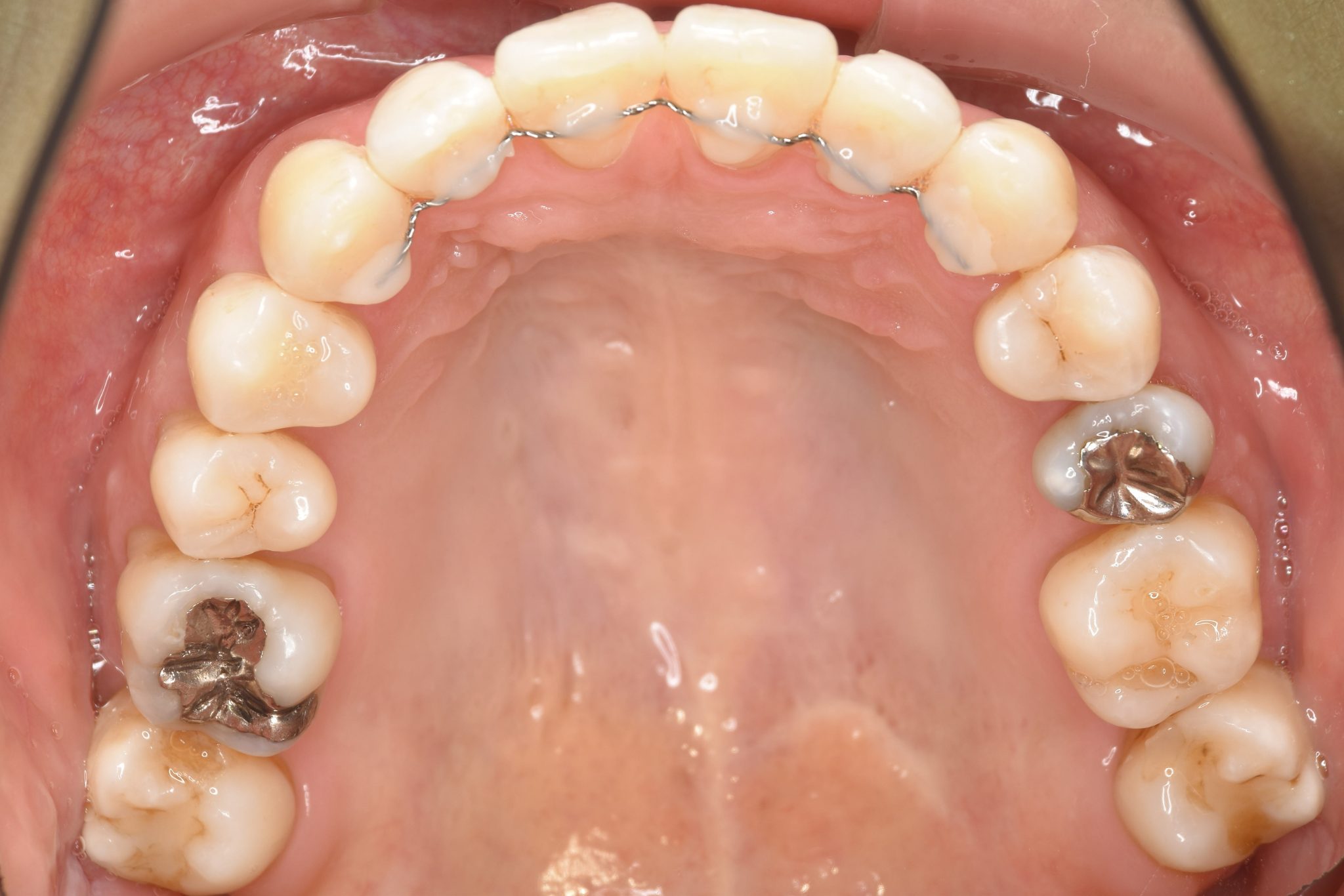 全顎ワイヤー矯正　症例_138