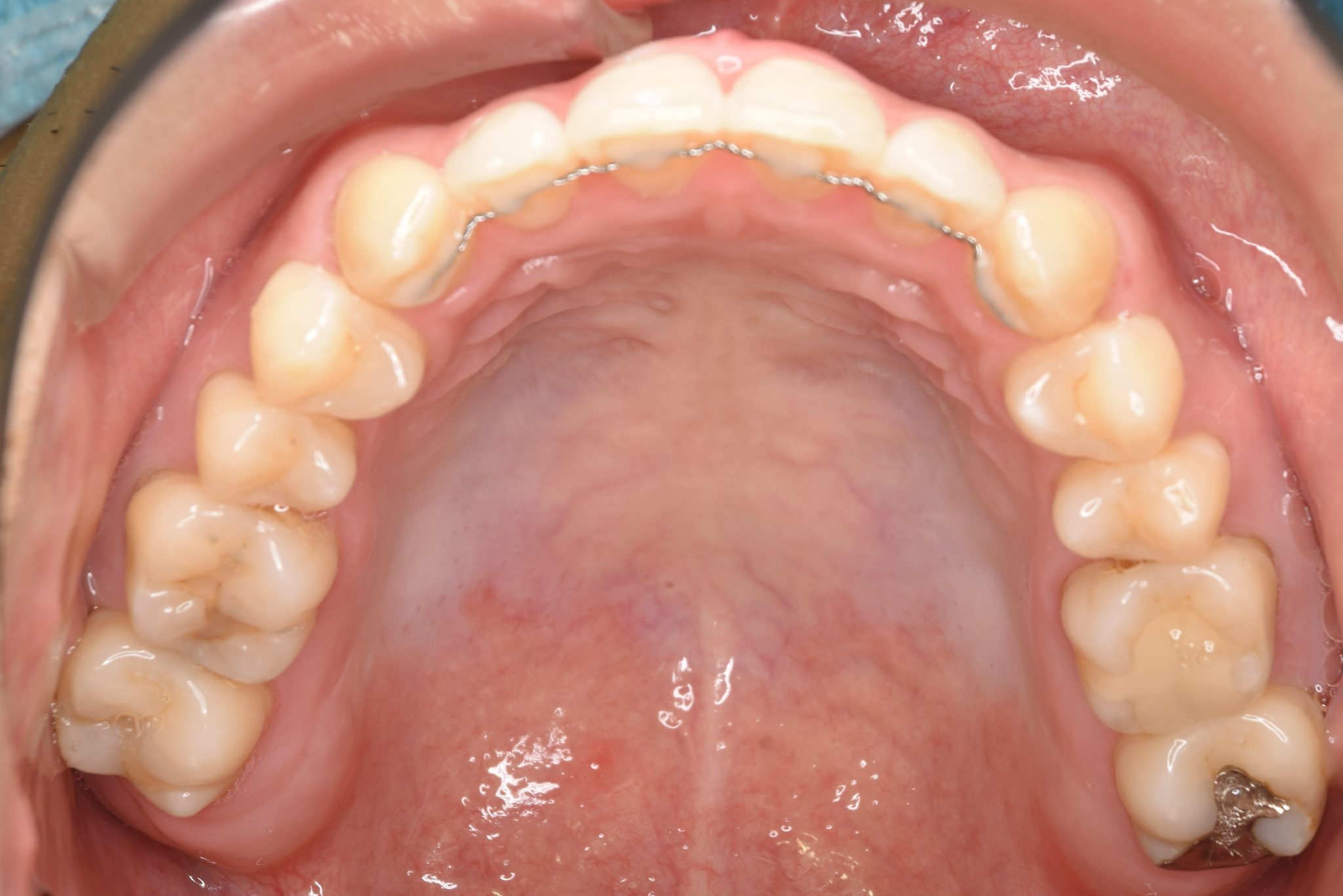 全顎ワイヤー矯正　症例_495