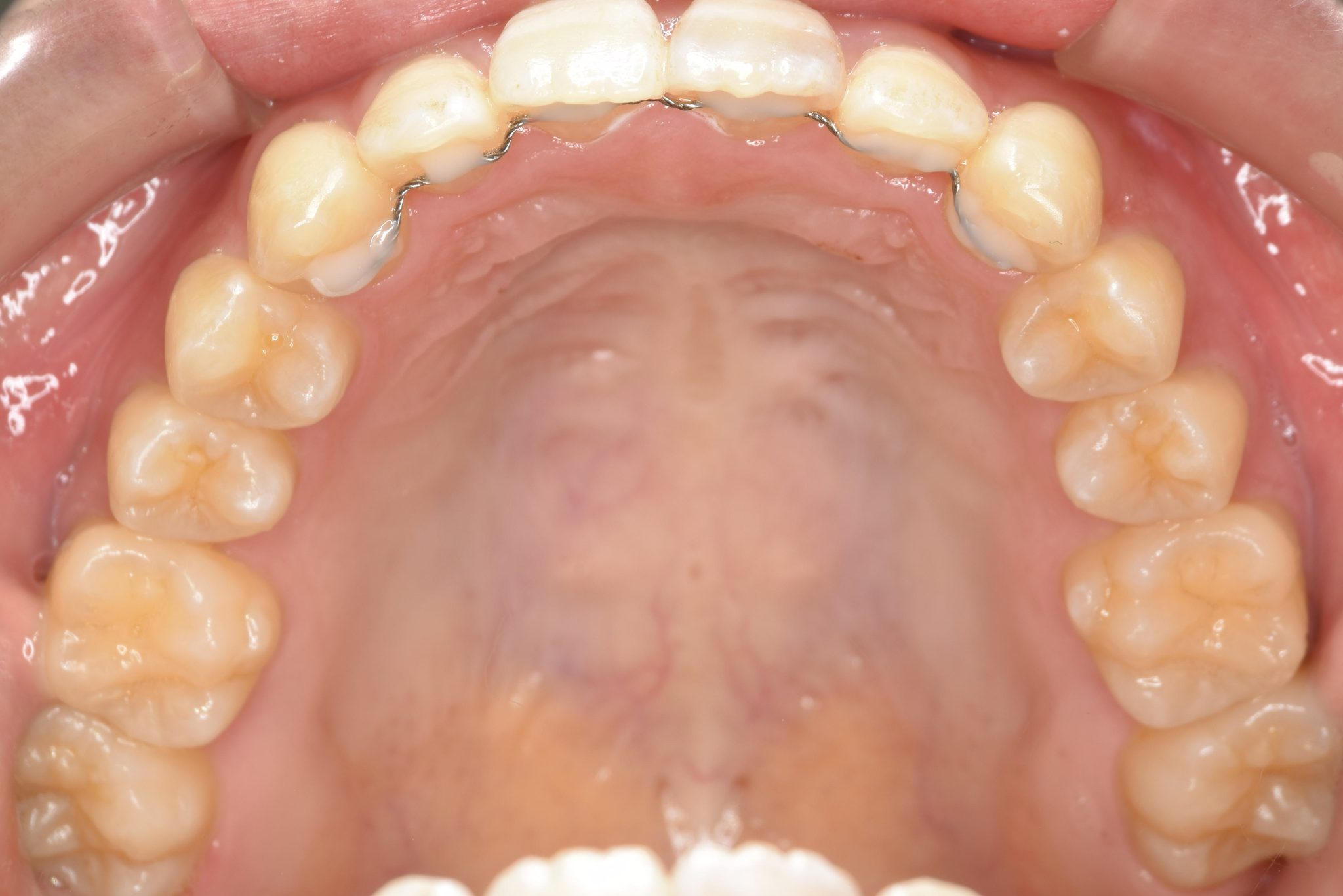 全顎ワイヤー矯正　症例_500