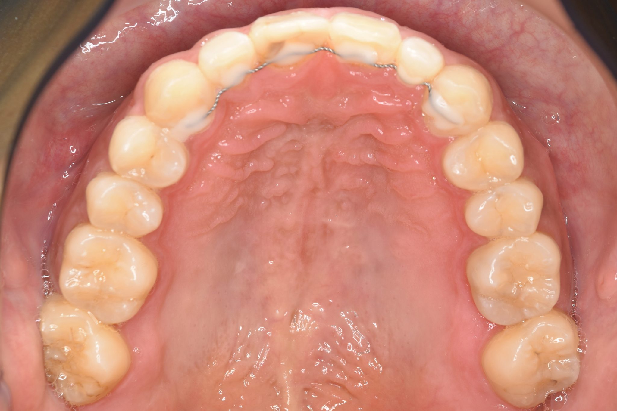 全顎ワイヤー矯正　症例_510