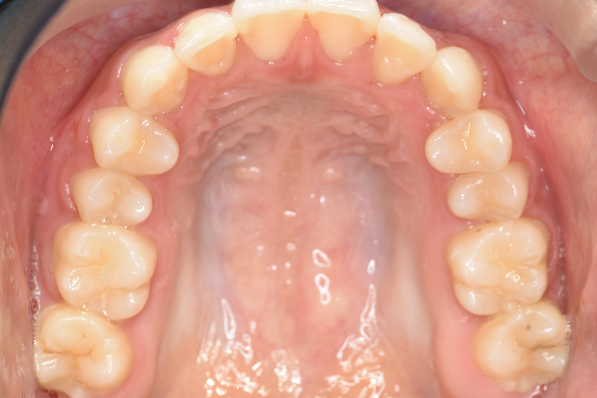 全顎ワイヤー矯正　症例_551