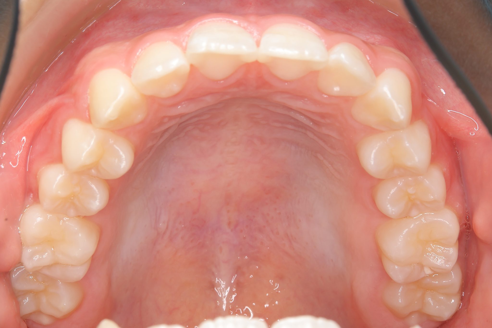 全顎ワイヤー矯正　症例_610