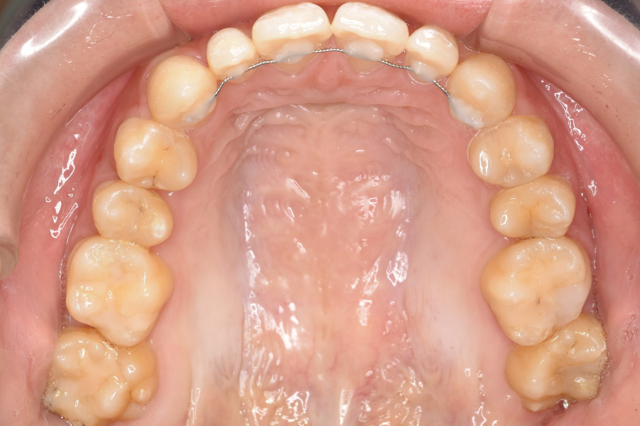 全顎ワイヤー矯正　症例_640