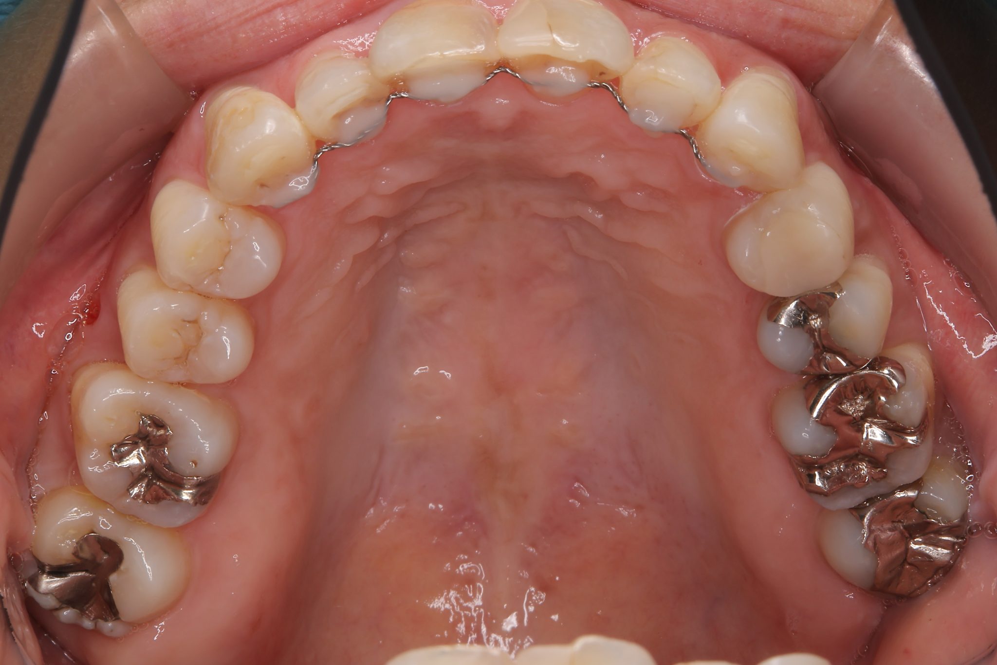 全顎ワイヤー矯正　症例_649