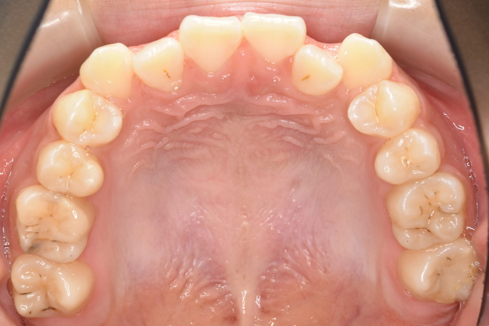 全顎ワイヤー矯正　症例_139