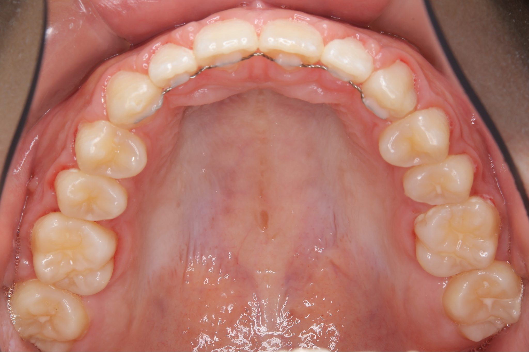 全顎ワイヤー矯正　症例_681