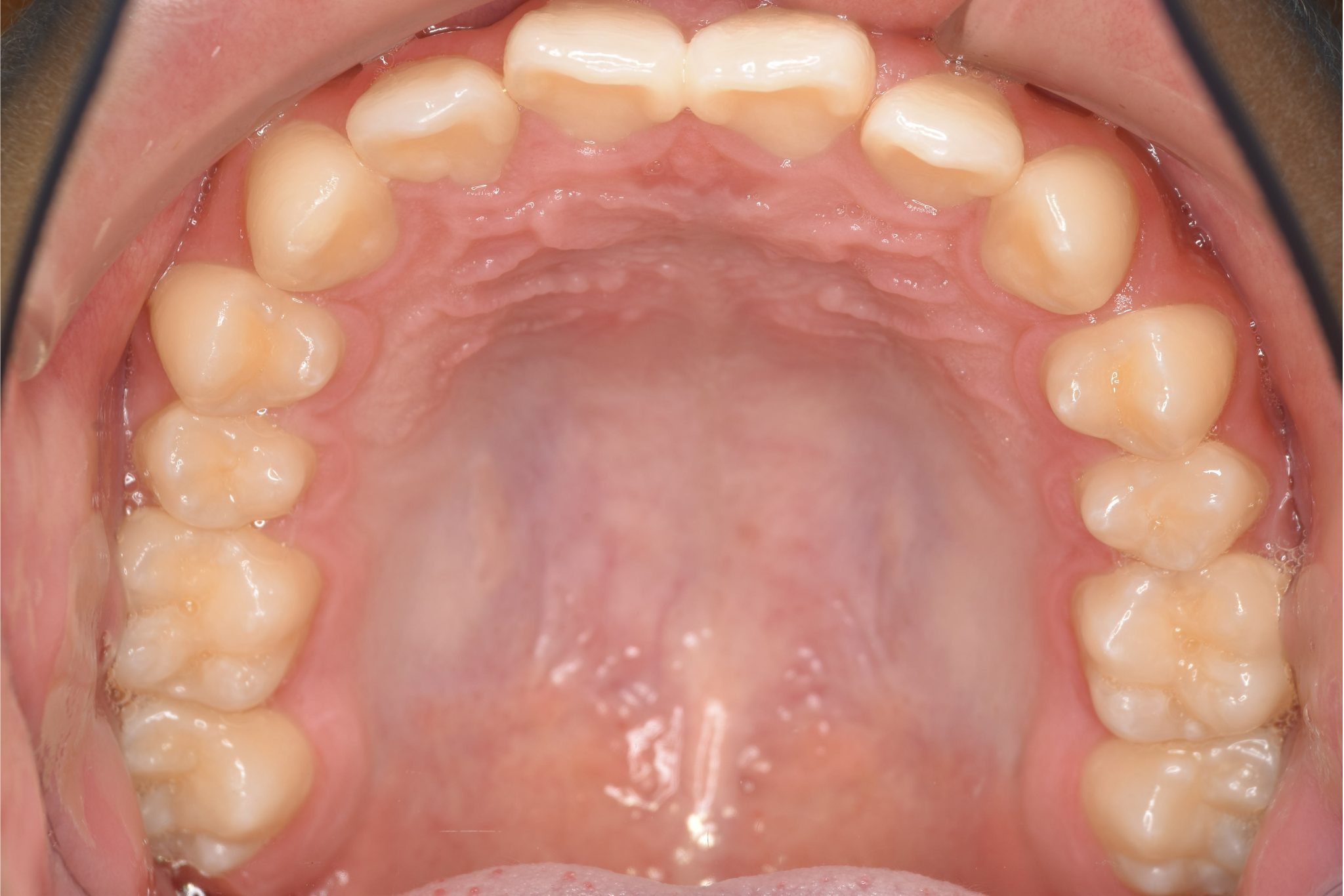 全顎ワイヤー矯正　症例_758