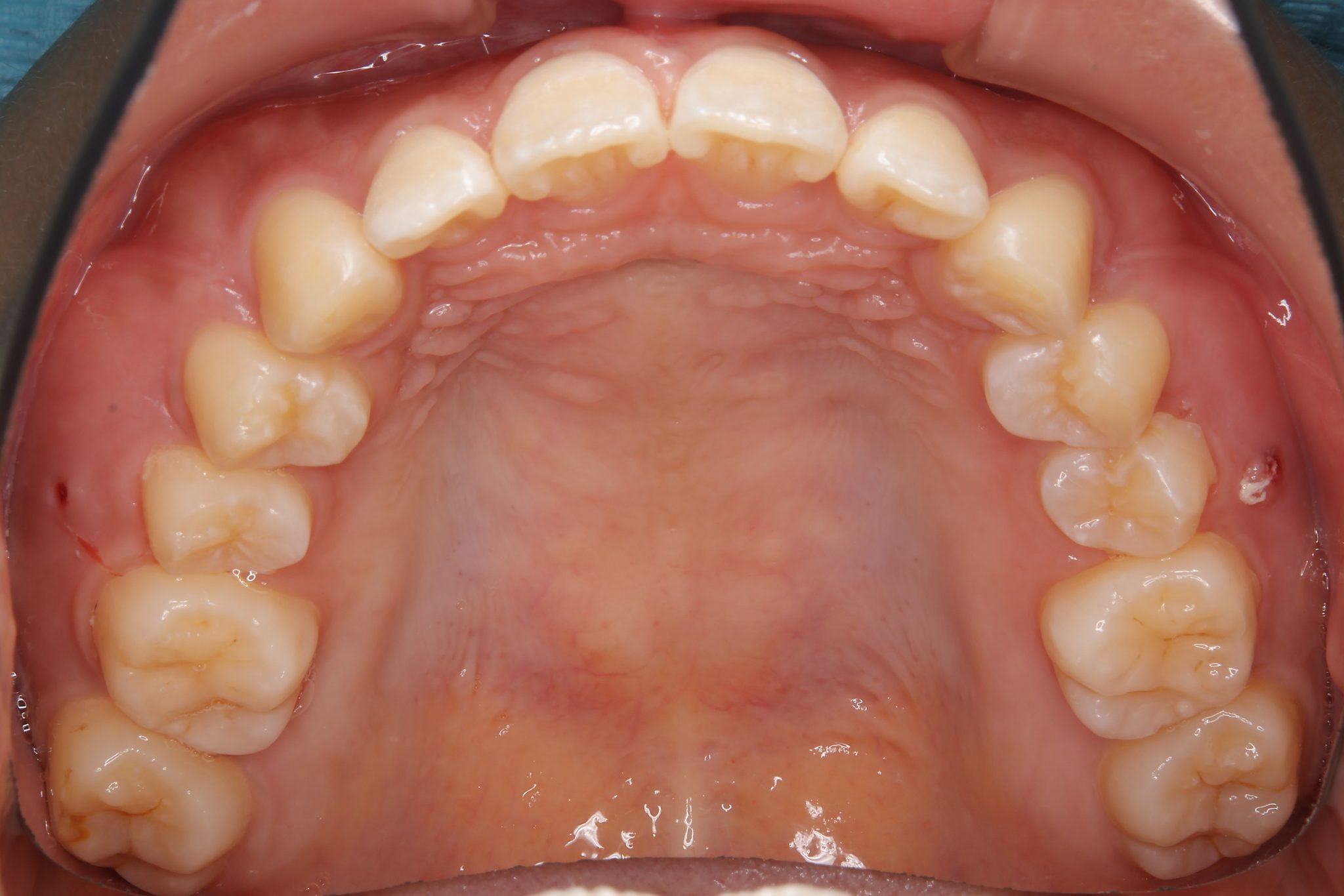 全顎ワイヤー矯正　症例_793