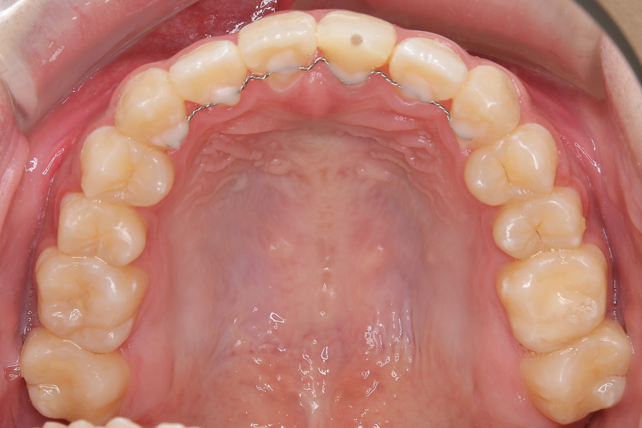 全顎ワイヤー矯正　症例_798