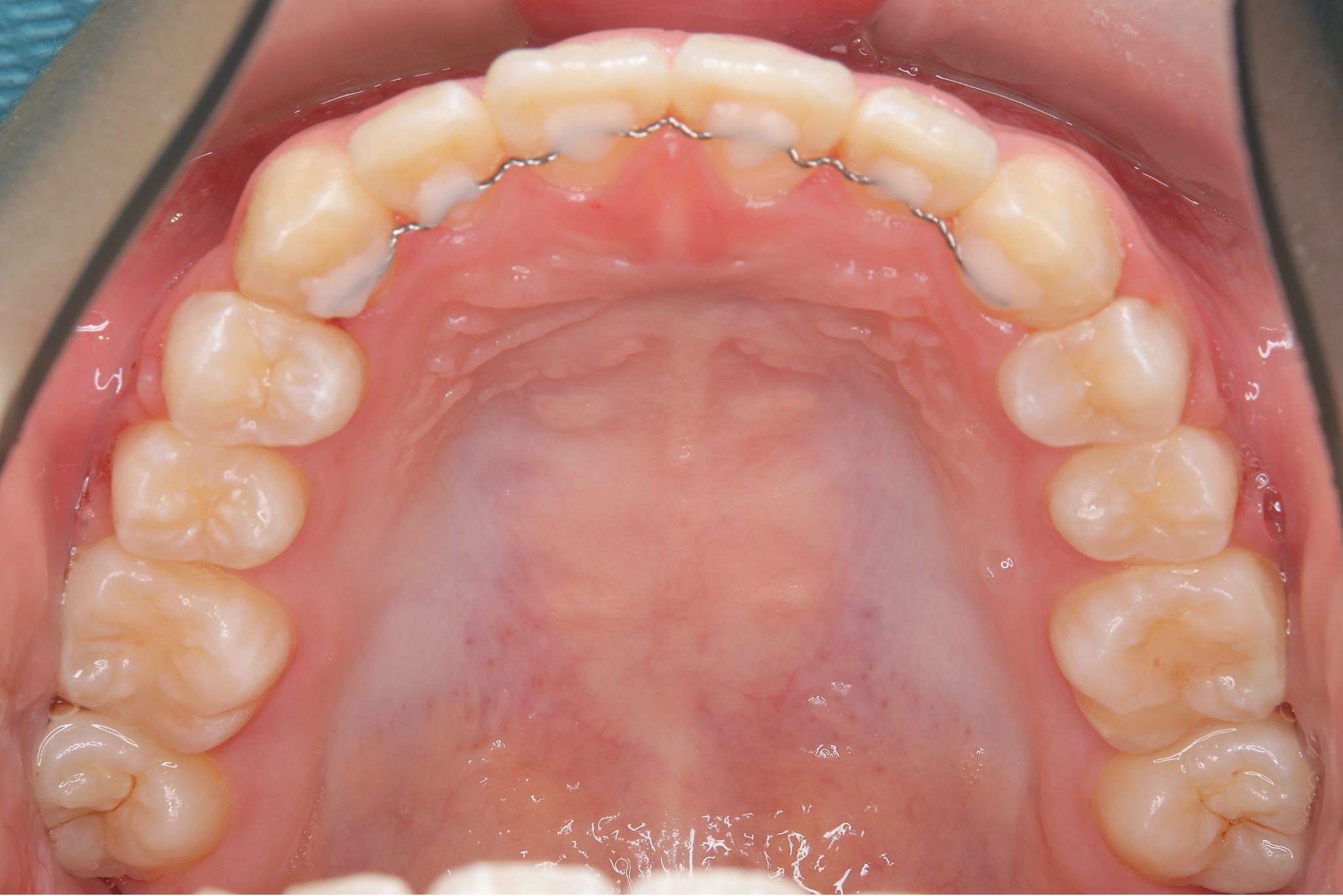 全顎ワイヤー矯正　症例_805