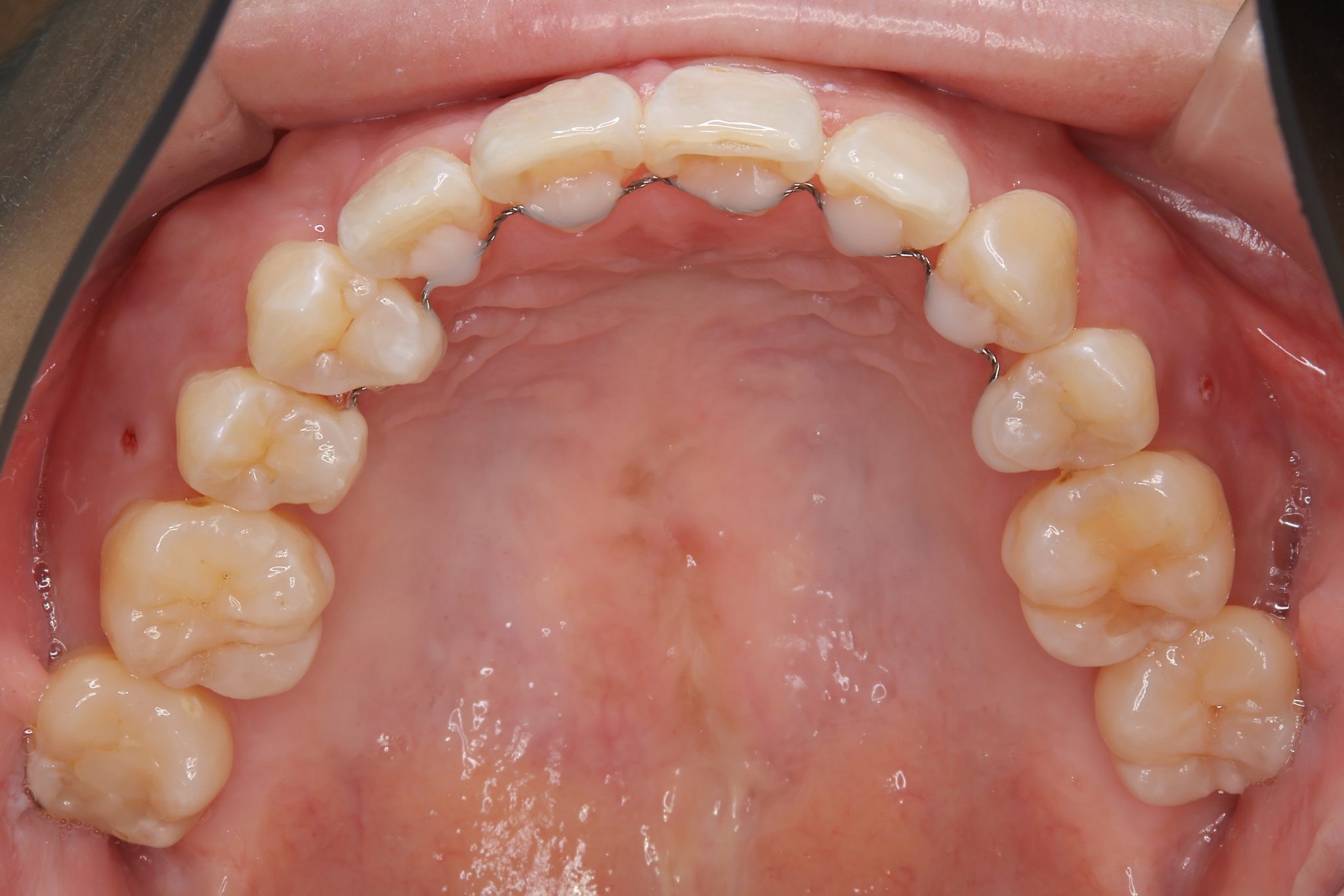全顎ワイヤー矯正　症例_814