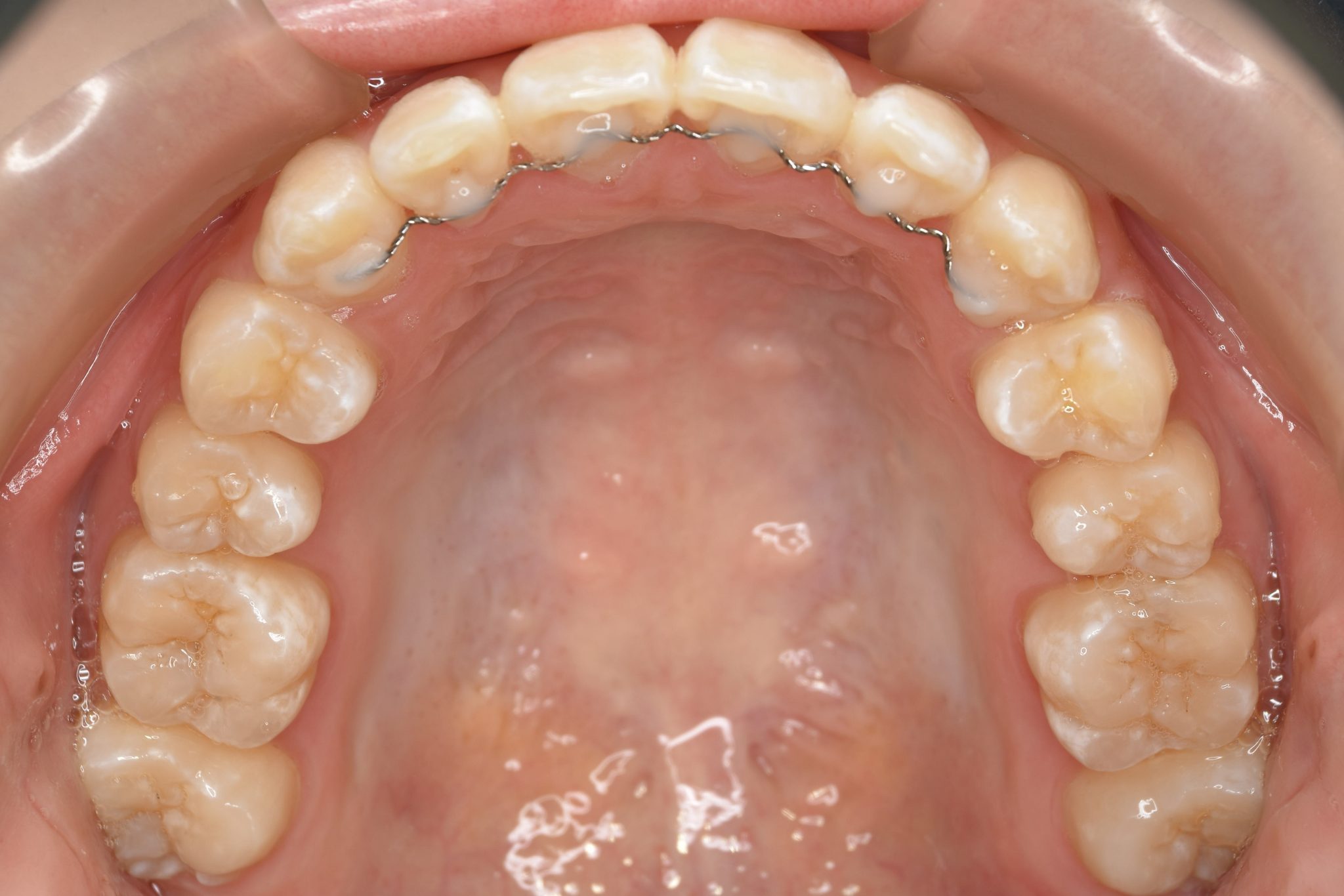 全顎ワイヤー矯正　症例_815